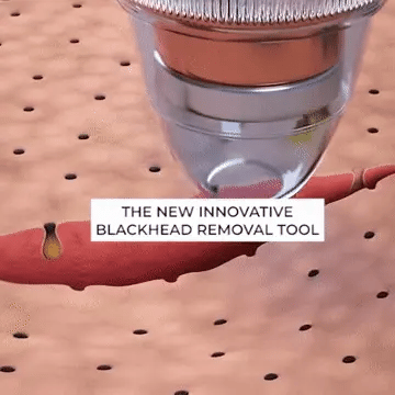 Glamzy Collection® Blackheads Remover Vacuum